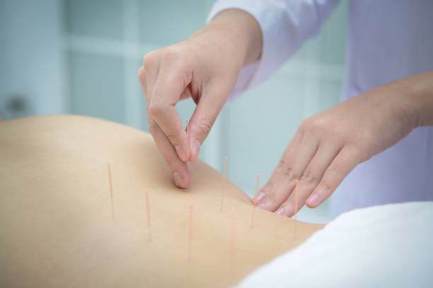 Understanding the Long-Term Benefits of Acupuncture for Weight Loss - WriteUpCafe.com